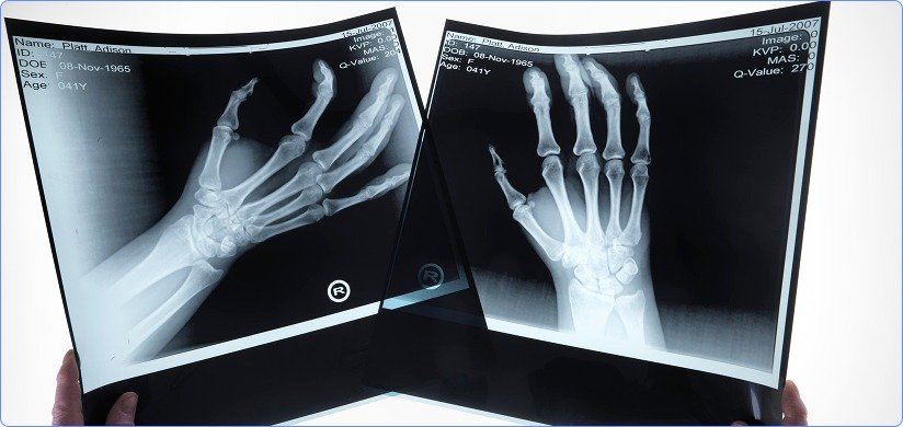 Upper Limbs X-Ray Reporting